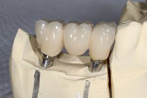 Dental Implants