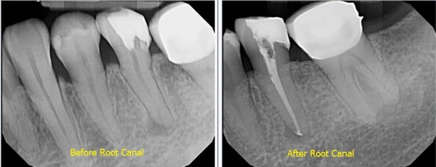 Root Canal Therapy
